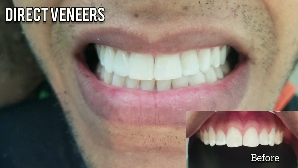 IMPROVE YOUR SMILE WITH VENEERS - CTG ENGLISH DENTIST