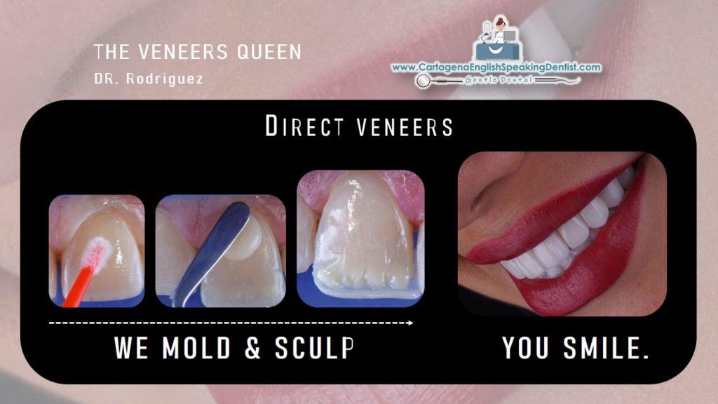 IMPROVE YOUR SMILE WITH VENEERS - CTG ENGLISH DENTIST