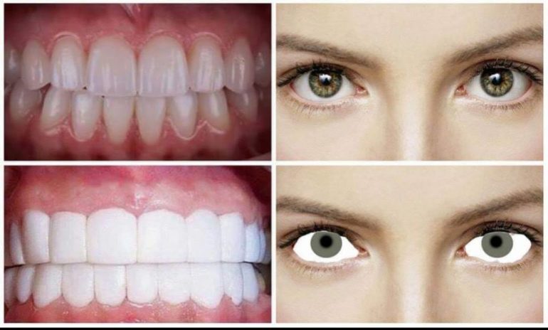 HOW TO SELECT THE RIGHT SHADE? ⋆ VENEERS - CED