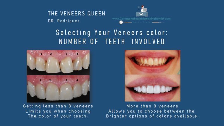 HOW TO SELECT THE RIGHT SHADE? ⋆ VENEERS - CED