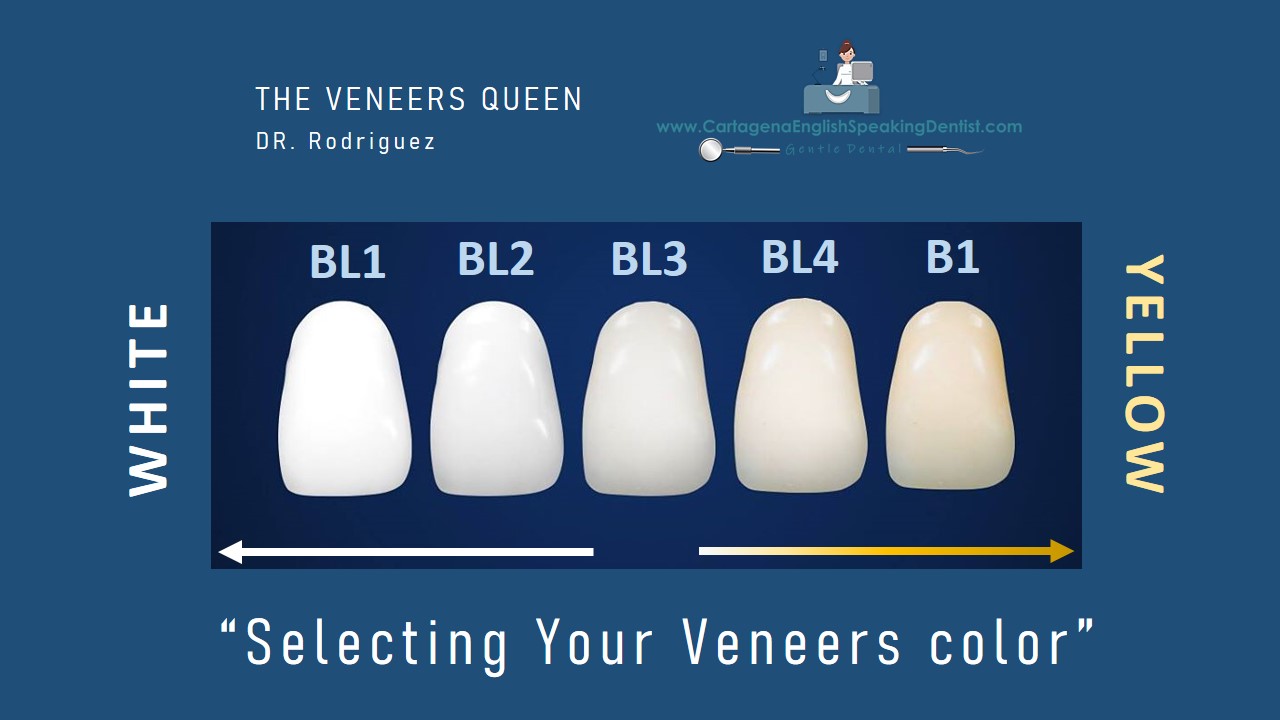 Porcelain Veneers Color Chart