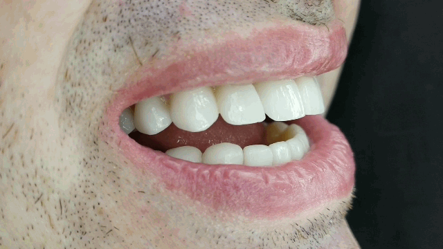 veneers cartagena english dentist