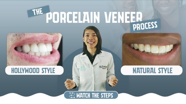 PORCELAIN VENEERS