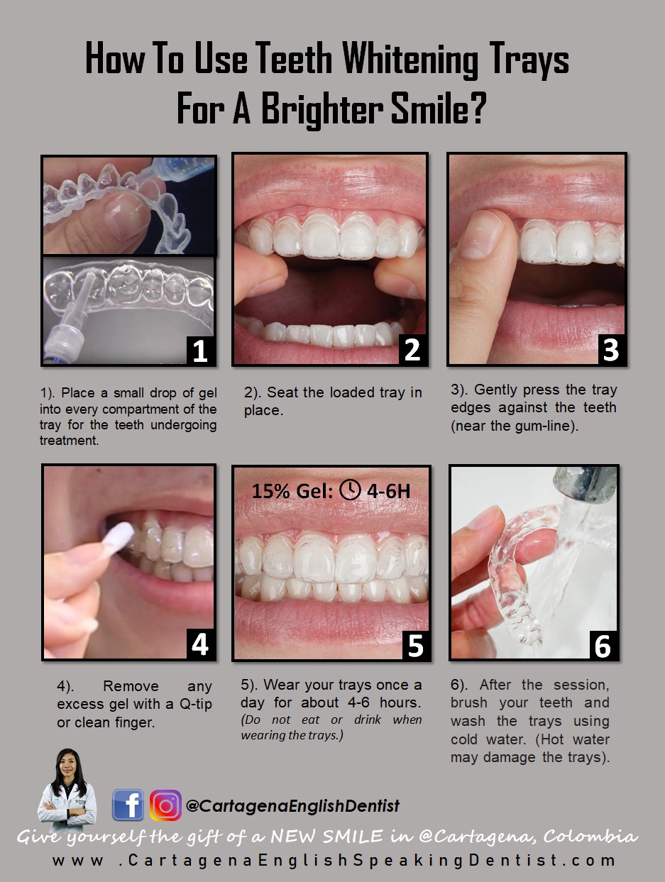 Custom Whitening Tray Instructions ⋆ How To Use Them 