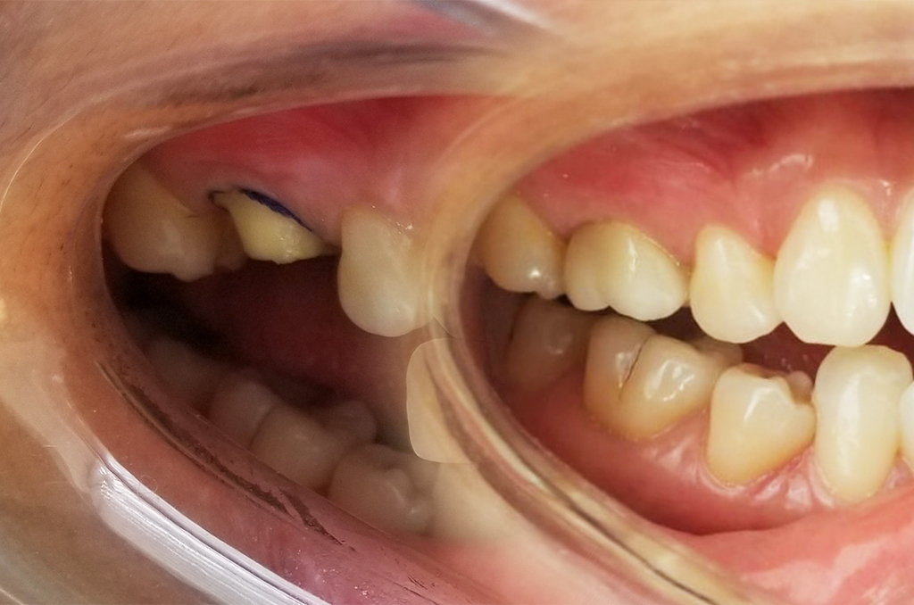 Dental Crowns - Cartagena English Speaking Dentist