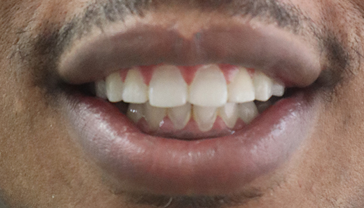 Marlon before