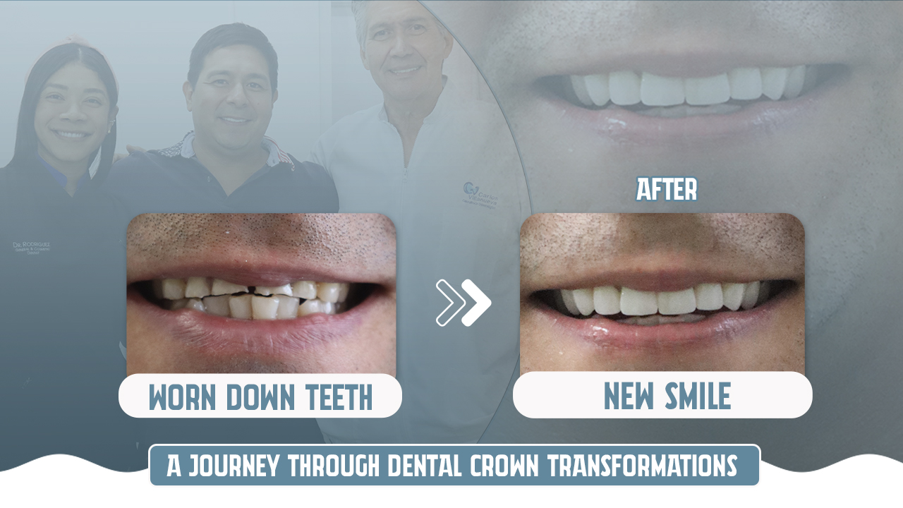 FROM WORN DOWN TEETH TO A WONDERFUL NEW SMILE