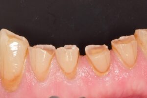 Teeth Grinding