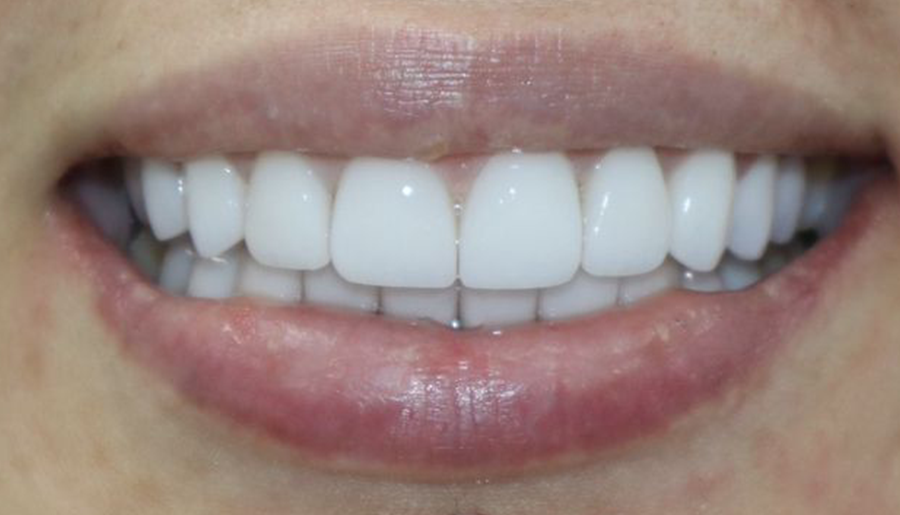 E-Max dental restoration in Cartagena, Colombia