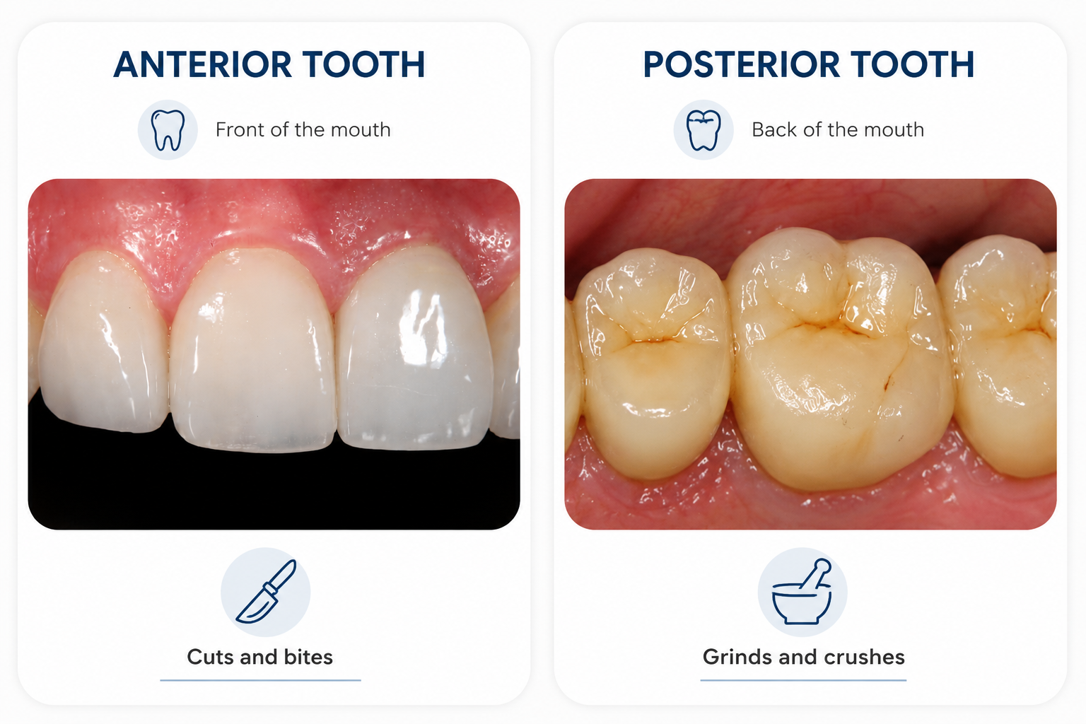 E-Max vs zirconia dental restoration comparison