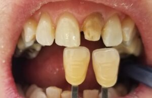 Before and after of a dark tooth restored with a zirconia crown