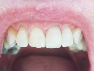 Before & After of a dark tooth restored with a zirconia crown