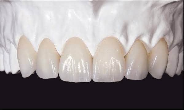 Natural-looking zirconia dental crown in Cartagena, Colombia