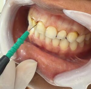 Gum Contouring Procedure In Cartagena