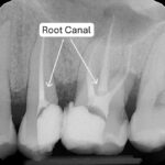 Root Canal Cartagena